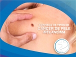 Conheça os tipos de câncer de pele melanoma e não melanoma